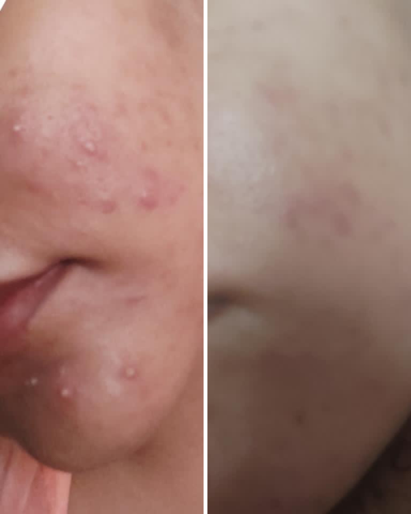 Anti Acne & Glowing Serum Vitamin C + E